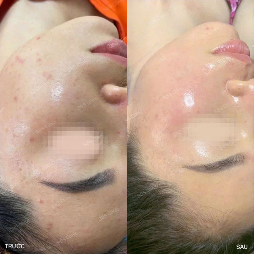 Khách hàng tiêm mesotherapy