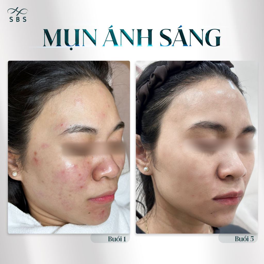 dieu-tri-mun-anh-sang-sbs-clinic-66
